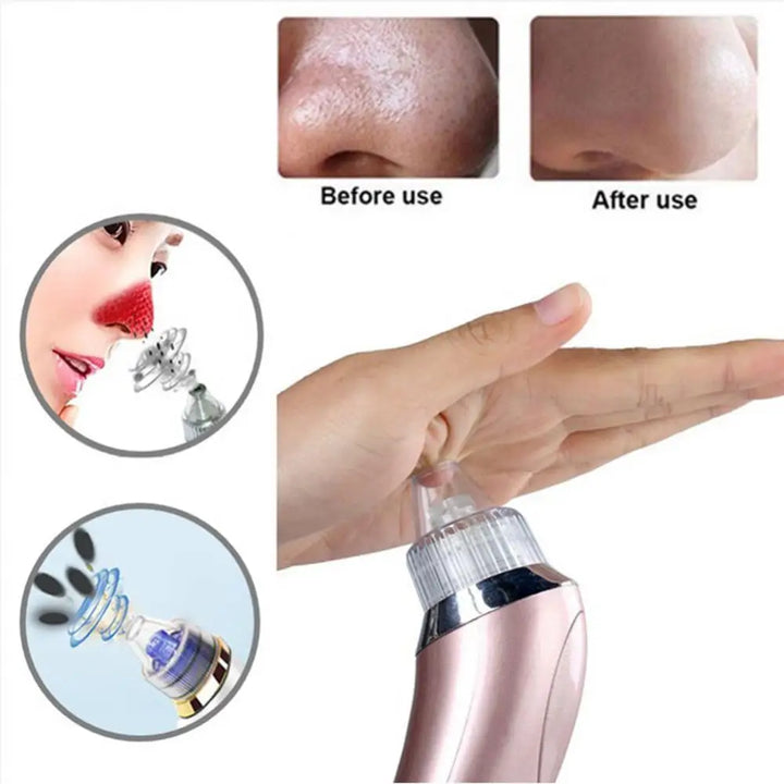 Cleaner Blackhead Remover