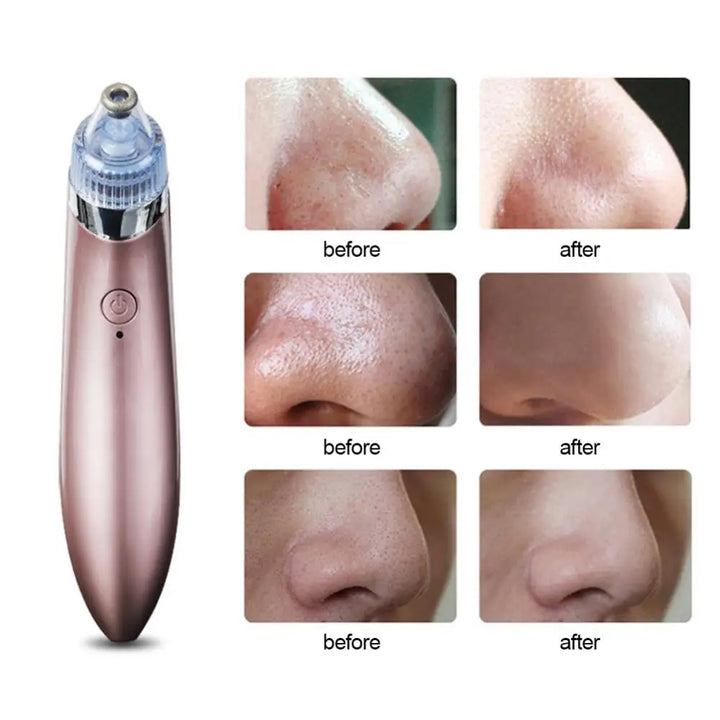 Cleaner Blackhead Remover